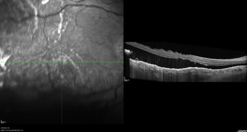 Choroidal Metastatic Breast Cancer with Exudative Detachment
58 year old female presented with 20/200 vision.  Had 10 sessions of radiation and tumor shrank.  The exudative detachment took almost a year to resolve.  The vision improved to 20/40.
