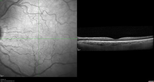 Choroidal Metastatic Breast Cancer with Exudative Detachment
58 year old female presented with 20/200 vision.  Had 10 sessions of radiation and tumor shrank.  The exudative detachment took almost a year to resolve.  The vision improved to 20/40.
