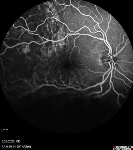 Choroidal Metastatic Breast Cancer with Exudative Detachment
58 year old female presented with 20/200 vision.  Had 10 sessions of radiation and tumor shrank.  The exudative detachment took almost a year to resolve.  The vision improved to 20/40.
