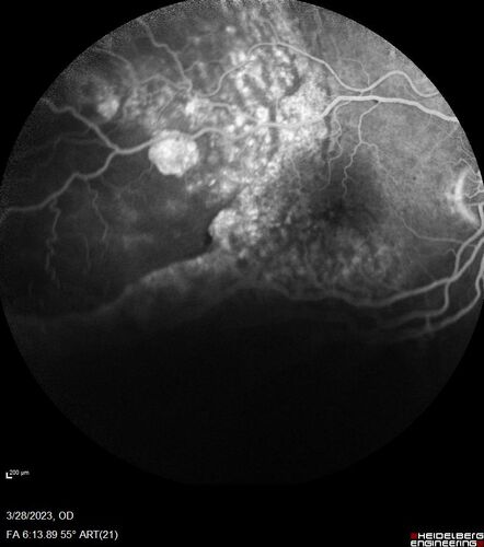 Choroidal Metastatic Breast Cancer with Exudative Detachment
58 year old female presented with 20/200 vision.  Had 10 sessions of radiation and tumor shrank.  The exudative detachment took almost a year to resolve.  The vision improved to 20/40.
