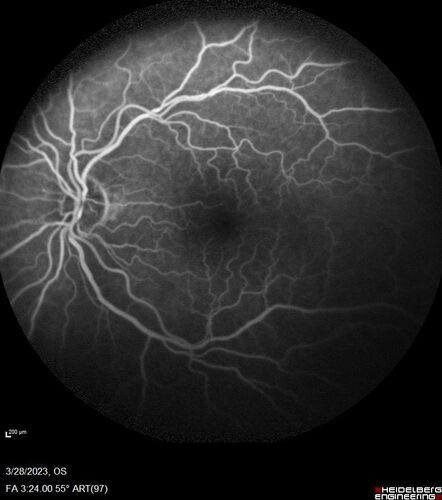 Choroidal Metastatic Breast Cancer with Exudative Detachment
58 year old female presented with 20/200 vision.  Had 10 sessions of radiation and tumor shrank.  The exudative detachment took almost a year to resolve.  The vision improved to 20/40.

