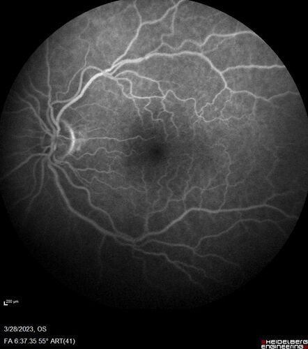 Choroidal Metastatic Breast Cancer with Exudative Detachment
58 year old female presented with 20/200 vision.  Had 10 sessions of radiation and tumor shrank.  The exudative detachment took almost a year to resolve.  The vision improved to 20/40.
