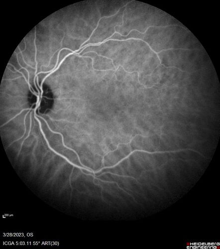 Choroidal Metastatic Breast Cancer with Exudative Detachment
58 year old female presented with 20/200 vision.  Had 10 sessions of radiation and tumor shrank.  The exudative detachment took almost a year to resolve.  The vision improved to 20/40.
