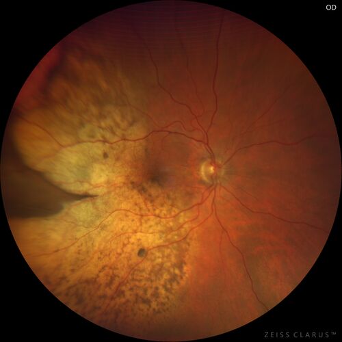Choroidal Metastatic Breast Cancer with Exudative Detachment
58 year old female presented with 20/200 vision.  Had 10 sessions of radiation and tumor shrank.  The exudative detachment took almost a year to resolve.  The vision improved to 20/40.

