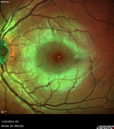 Recurrent MEWDS Left Eye - Teenage Girl
Patient presented in 2014 (first images) 2 months following vision loss left eye.  Vision went from 20/60 - 20/20.  OCT showed outer retinal irregularities which normalized.  Then 3 years later in 2017 she had full blown MEWDS.  She presented acutely and all the images are typical.  Both episodes where in the same time of year, about 3 months after her flu shot for sports.
