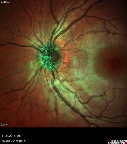 Recurrent MEWDS Left Eye - Teenage Girl
Patient presented in 2014 (first images) 2 months following vision loss left eye.  Vision went from 20/60 - 20/20.  OCT showed outer retinal irregularities which normalized.  Then 3 years later in 2017 she had full blown MEWDS.  She presented acutely and all the images are typical.  Both episodes where in the same time of year, about 3 months after her flu shot for sports.
