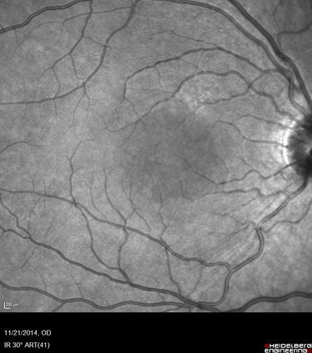 Recurrent MEWDS Left Eye - Teenage Girl
Patient presented in 2014 (first images) 2 months following vision loss left eye.  Vision went from 20/60 - 20/20.  OCT showed outer retinal irregularities which normalized.  Then 3 years later in 2017 she had full blown MEWDS.  She presented acutely and all the images are typical.  Both episodes where in the same time of year, about 3 months after her flu shot for sports.
