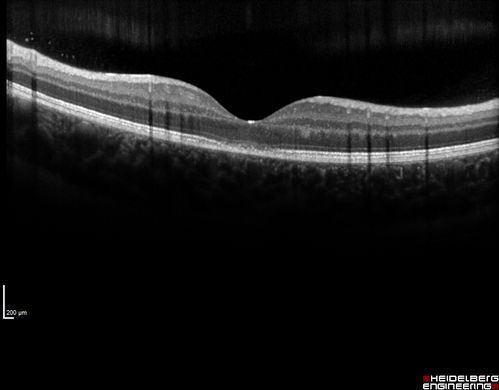 Recurrent MEWDS Left Eye - Teenage Girl
Patient presented in 2014 (first images) 2 months following vision loss left eye.  Vision went from 20/60 - 20/20.  OCT showed outer retinal irregularities which normalized.  Then 3 years later in 2017 she had full blown MEWDS.  She presented acutely and all the images are typical.  Both episodes where in the same time of year, about 3 months after her flu shot for sports.
