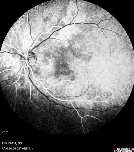Recurrent MEWDS Left Eye - Teenage Girl
Patient presented in 2014 (first images) 2 months following vision loss left eye.  Vision went from 20/60 - 20/20.  OCT showed outer retinal irregularities which normalized.  Then 3 years later in 2017 she had full blown MEWDS.  She presented acutely and all the images are typical.  Both episodes where in the same time of year, about 3 months after her flu shot for sports.
