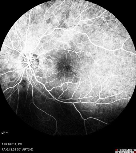 Recurrent MEWDS Left Eye - Teenage Girl
Patient presented in 2014 (first images) 2 months following vision loss left eye.  Vision went from 20/60 - 20/20.  OCT showed outer retinal irregularities which normalized.  Then 3 years later in 2017 she had full blown MEWDS.  She presented acutely and all the images are typical.  Both episodes where in the same time of year, about 3 months after her flu shot for sports.
