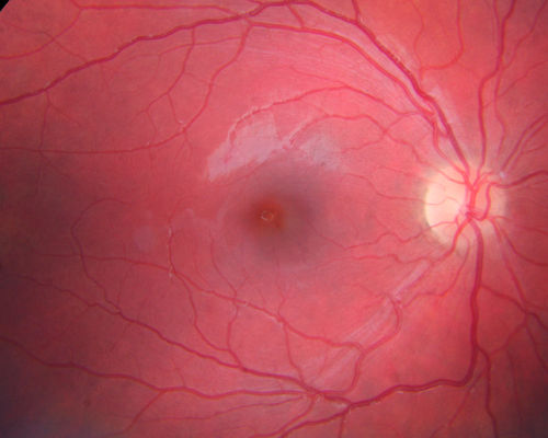 Recurrent MEWDS Left Eye - Teenage Girl
Patient presented in 2014 (first images) 2 months following vision loss left eye.  Vision went from 20/60 - 20/20.  OCT showed outer retinal irregularities which normalized.  Then 3 years later in 2017 she had full blown MEWDS.  She presented acutely and all the images are typical.  Both episodes where in the same time of year, about 3 months after her flu shot for sports.
