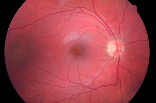 Recurrent MEWDS Left Eye - Teenage Girl
Patient presented in 2014 (first images) 2 months following vision loss left eye.  Vision went from 20/60 - 20/20.  OCT showed outer retinal irregularities which normalized.  Then 3 years later in 2017 she had full blown MEWDS.  She presented acutely and all the images are typical.  Both episodes where in the same time of year, about 3 months after her flu shot for sports.
