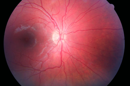 Recurrent MEWDS Left Eye - Teenage Girl
Patient presented in 2014 (first images) 2 months following vision loss left eye.  Vision went from 20/60 - 20/20.  OCT showed outer retinal irregularities which normalized.  Then 3 years later in 2017 she had full blown MEWDS.  She presented acutely and all the images are typical.  Both episodes where in the same time of year, about 3 months after her flu shot for sports.
