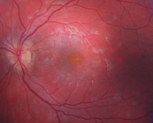 Recurrent MEWDS Left Eye - Teenage Girl
Patient presented in 2014 (first images) 2 months following vision loss left eye.  Vision went from 20/60 - 20/20.  OCT showed outer retinal irregularities which normalized.  Then 3 years later in 2017 she had full blown MEWDS.  She presented acutely and all the images are typical.  Both episodes where in the same time of year, about 3 months after her flu shot for sports.
