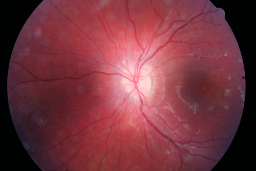 Recurrent MEWDS Left Eye - Teenage Girl
Patient presented in 2014 (first images) 2 months following vision loss left eye.  Vision went from 20/60 - 20/20.  OCT showed outer retinal irregularities which normalized.  Then 3 years later in 2017 she had full blown MEWDS.  She presented acutely and all the images are typical.  Both episodes where in the same time of year, about 3 months after her flu shot for sports.
