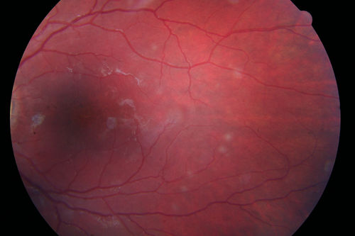 Recurrent MEWDS Left Eye - Teenage Girl
Patient presented in 2014 (first images) 2 months following vision loss left eye.  Vision went from 20/60 - 20/20.  OCT showed outer retinal irregularities which normalized.  Then 3 years later in 2017 she had full blown MEWDS.  She presented acutely and all the images are typical.  Both episodes where in the same time of year, about 3 months after her flu shot for sports.
