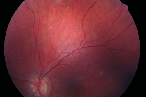Recurrent MEWDS Left Eye - Teenage Girl
Patient presented in 2014 (first images) 2 months following vision loss left eye.  Vision went from 20/60 - 20/20.  OCT showed outer retinal irregularities which normalized.  Then 3 years later in 2017 she had full blown MEWDS.  She presented acutely and all the images are typical.  Both episodes where in the same time of year, about 3 months after her flu shot for sports.
