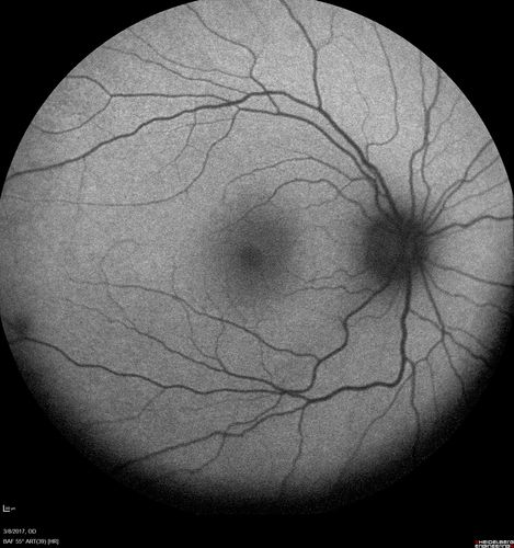 Recurrent MEWDS Left Eye - Teenage Girl
Patient presented in 2014 (first images) 2 months following vision loss left eye.  Vision went from 20/60 - 20/20.  OCT showed outer retinal irregularities which normalized.  Then 3 years later in 2017 she had full blown MEWDS.  She presented acutely and all the images are typical.  Both episodes where in the same time of year, about 3 months after her flu shot for sports.
