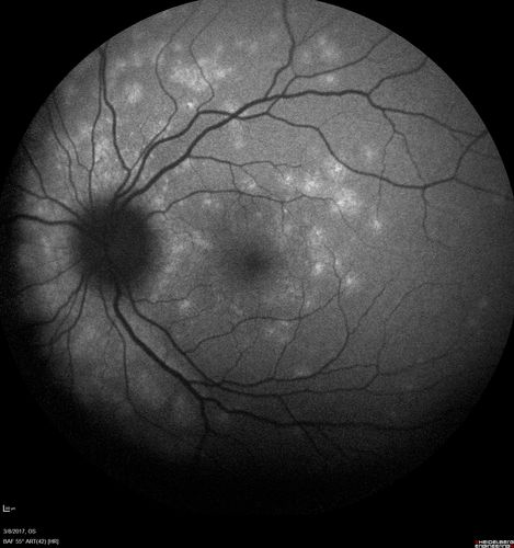 Recurrent MEWDS Left Eye - Teenage Girl
Patient presented in 2014 (first images) 2 months following vision loss left eye.  Vision went from 20/60 - 20/20.  OCT showed outer retinal irregularities which normalized.  Then 3 years later in 2017 she had full blown MEWDS.  She presented acutely and all the images are typical.  Both episodes where in the same time of year, about 3 months after her flu shot for sports.
