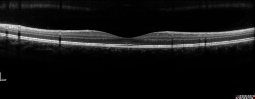 Recurrent MEWDS Left Eye - Teenage Girl
Patient presented in 2014 (first images) 2 months following vision loss left eye.  Vision went from 20/60 - 20/20.  OCT showed outer retinal irregularities which normalized.  Then 3 years later in 2017 she had full blown MEWDS.  She presented acutely and all the images are typical.  Both episodes where in the same time of year, about 3 months after her flu shot for sports.
