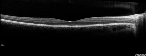 Recurrent MEWDS Left Eye - Teenage Girl
Patient presented in 2014 (first images) 2 months following vision loss left eye.  Vision went from 20/60 - 20/20.  OCT showed outer retinal irregularities which normalized.  Then 3 years later in 2017 she had full blown MEWDS.  She presented acutely and all the images are typical.  Both episodes where in the same time of year, about 3 months after her flu shot for sports.
