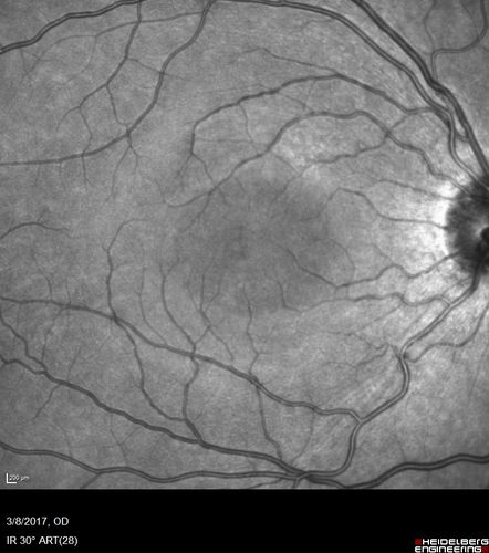 Recurrent MEWDS Left Eye - Teenage Girl
Patient presented in 2014 (first images) 2 months following vision loss left eye.  Vision went from 20/60 - 20/20.  OCT showed outer retinal irregularities which normalized.  Then 3 years later in 2017 she had full blown MEWDS.  She presented acutely and all the images are typical.  Both episodes where in the same time of year, about 3 months after her flu shot for sports.
