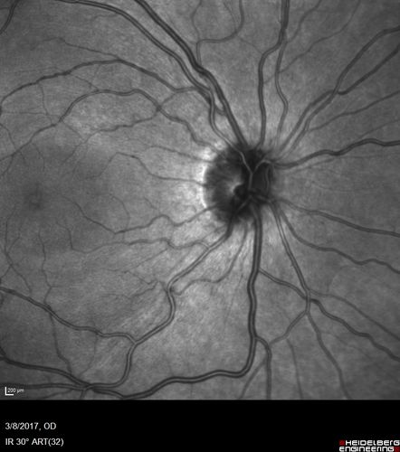 Recurrent MEWDS Left Eye - Teenage Girl
Patient presented in 2014 (first images) 2 months following vision loss left eye.  Vision went from 20/60 - 20/20.  OCT showed outer retinal irregularities which normalized.  Then 3 years later in 2017 she had full blown MEWDS.  She presented acutely and all the images are typical.  Both episodes where in the same time of year, about 3 months after her flu shot for sports.
