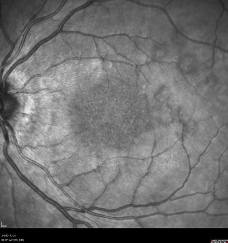 Recurrent MEWDS Left Eye - Teenage Girl
Patient presented in 2014 (first images) 2 months following vision loss left eye.  Vision went from 20/60 - 20/20.  OCT showed outer retinal irregularities which normalized.  Then 3 years later in 2017 she had full blown MEWDS.  She presented acutely and all the images are typical.  Both episodes where in the same time of year, about 3 months after her flu shot for sports.
