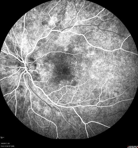 Recurrent MEWDS Left Eye - Teenage Girl
Patient presented in 2014 (first images) 2 months following vision loss left eye.  Vision went from 20/60 - 20/20.  OCT showed outer retinal irregularities which normalized.  Then 3 years later in 2017 she had full blown MEWDS.  She presented acutely and all the images are typical.  Both episodes where in the same time of year, about 3 months after her flu shot for sports.
