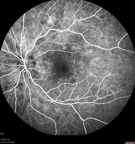 Recurrent MEWDS Left Eye - Teenage Girl
Patient presented in 2014 (first images) 2 months following vision loss left eye.  Vision went from 20/60 - 20/20.  OCT showed outer retinal irregularities which normalized.  Then 3 years later in 2017 she had full blown MEWDS.  She presented acutely and all the images are typical.  Both episodes where in the same time of year, about 3 months after her flu shot for sports.

