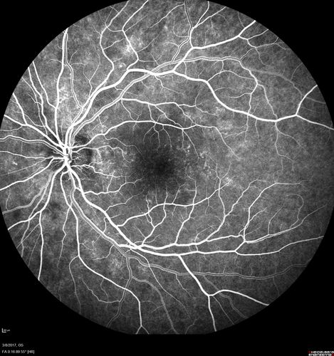Recurrent MEWDS Left Eye - Teenage Girl
Patient presented in 2014 (first images) 2 months following vision loss left eye.  Vision went from 20/60 - 20/20.  OCT showed outer retinal irregularities which normalized.  Then 3 years later in 2017 she had full blown MEWDS.  She presented acutely and all the images are typical.  Both episodes where in the same time of year, about 3 months after her flu shot for sports.
