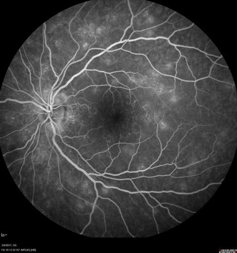 Recurrent MEWDS Left Eye - Teenage Girl
Patient presented in 2014 (first images) 2 months following vision loss left eye.  Vision went from 20/60 - 20/20.  OCT showed outer retinal irregularities which normalized.  Then 3 years later in 2017 she had full blown MEWDS.  She presented acutely and all the images are typical.  Both episodes where in the same time of year, about 3 months after her flu shot for sports.
