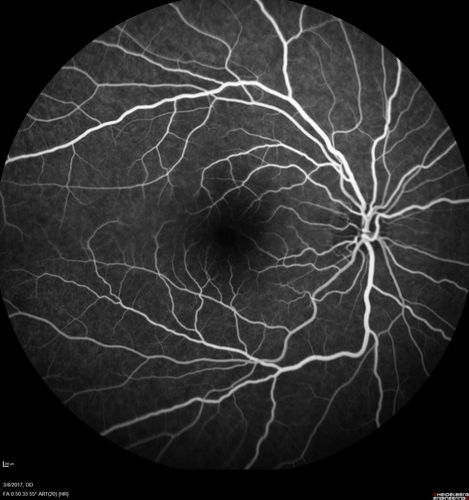 Recurrent MEWDS Left Eye - Teenage Girl
Patient presented in 2014 (first images) 2 months following vision loss left eye.  Vision went from 20/60 - 20/20.  OCT showed outer retinal irregularities which normalized.  Then 3 years later in 2017 she had full blown MEWDS.  She presented acutely and all the images are typical.  Both episodes where in the same time of year, about 3 months after her flu shot for sports.
