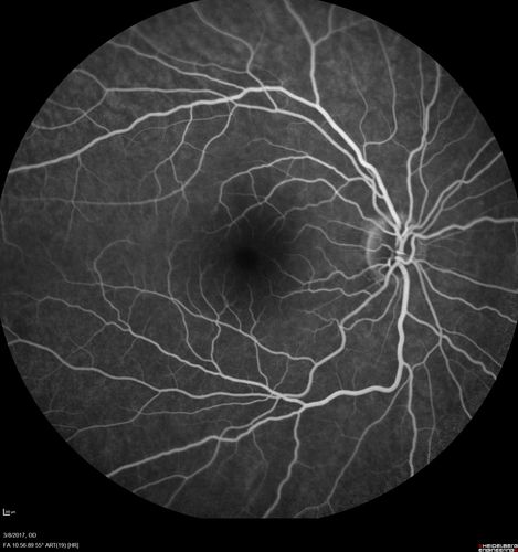Recurrent MEWDS Left Eye - Teenage Girl
Patient presented in 2014 (first images) 2 months following vision loss left eye.  Vision went from 20/60 - 20/20.  OCT showed outer retinal irregularities which normalized.  Then 3 years later in 2017 she had full blown MEWDS.  She presented acutely and all the images are typical.  Both episodes where in the same time of year, about 3 months after her flu shot for sports.
