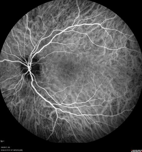 Recurrent MEWDS Left Eye - Teenage Girl
Patient presented in 2014 (first images) 2 months following vision loss left eye.  Vision went from 20/60 - 20/20.  OCT showed outer retinal irregularities which normalized.  Then 3 years later in 2017 she had full blown MEWDS.  She presented acutely and all the images are typical.  Both episodes where in the same time of year, about 3 months after her flu shot for sports.
