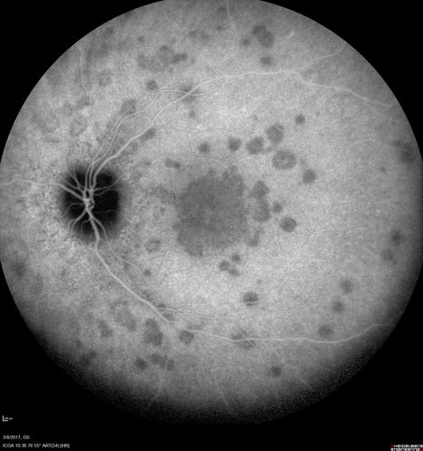 Recurrent MEWDS Left Eye - Teenage Girl
Patient presented in 2014 (first images) 2 months following vision loss left eye.  Vision went from 20/60 - 20/20.  OCT showed outer retinal irregularities which normalized.  Then 3 years later in 2017 she had full blown MEWDS.  She presented acutely and all the images are typical.  Both episodes where in the same time of year, about 3 months after her flu shot for sports.
