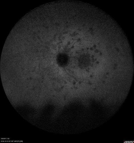 Recurrent MEWDS Left Eye - Teenage Girl
Patient presented in 2014 (first images) 2 months following vision loss left eye.  Vision went from 20/60 - 20/20.  OCT showed outer retinal irregularities which normalized.  Then 3 years later in 2017 she had full blown MEWDS.  She presented acutely and all the images are typical.  Both episodes where in the same time of year, about 3 months after her flu shot for sports.
