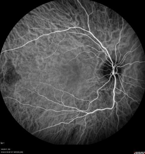 Recurrent MEWDS Left Eye - Teenage Girl
Patient presented in 2014 (first images) 2 months following vision loss left eye.  Vision went from 20/60 - 20/20.  OCT showed outer retinal irregularities which normalized.  Then 3 years later in 2017 she had full blown MEWDS.  She presented acutely and all the images are typical.  Both episodes where in the same time of year, about 3 months after her flu shot for sports.
