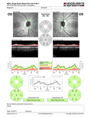 Recurrent MEWDS Left Eye - Teenage Girl
Patient presented in 2014 (first images) 2 months following vision loss left eye.  Vision went from 20/60 - 20/20.  OCT showed outer retinal irregularities which normalized.  Then 3 years later in 2017 she had full blown MEWDS.  She presented acutely and all the images are typical.  Both episodes where in the same time of year, about 3 months after her flu shot for sports.
