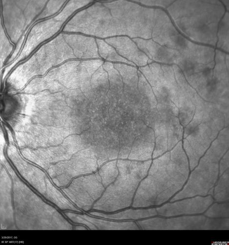 Recurrent MEWDS Left Eye - Teenage Girl
Patient presented in 2014 (first images) 2 months following vision loss left eye.  Vision went from 20/60 - 20/20.  OCT showed outer retinal irregularities which normalized.  Then 3 years later in 2017 she had full blown MEWDS.  She presented acutely and all the images are typical.  Both episodes where in the same time of year, about 3 months after her flu shot for sports.
