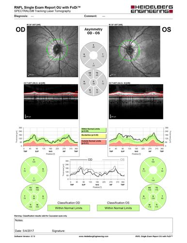 Recurrent MEWDS Left Eye - Teenage Girl
Patient presented in 2014 (first images) 2 months following vision loss left eye.  Vision went from 20/60 - 20/20.  OCT showed outer retinal irregularities which normalized.  Then 3 years later in 2017 she had full blown MEWDS.  She presented acutely and all the images are typical.  Both episodes where in the same time of year, about 3 months after her flu shot for sports.
