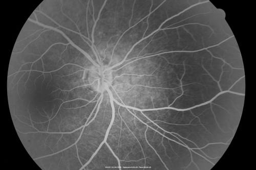 Multiple Evanescent White Dot Syndrome - Acute Idiopathic Blind Spot Enlargement
33-year-old woman one week ago she awoke and saw a red spots flashing out of her right eye.  She notices them to the right side, which is the temporal visual field out of the right eye, then they changed to bursts of white lights without colors and then she notices straight ahead a couple spots.  She has headaches in the back of her head.  OD 20/20, OS 20/20
Keywords: mewds;aibse