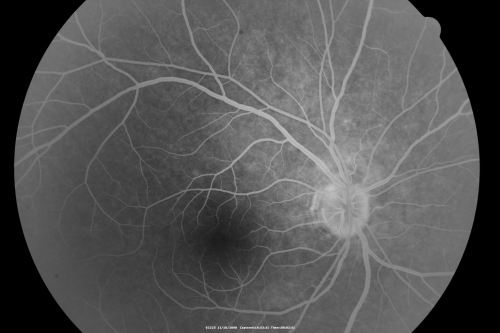 Multiple Evanescent White Dot Syndrome - Acute Idiopathic Blind Spot Enlargement
33-year-old woman one week ago she awoke and saw a red spots flashing out of her right eye.  She notices them to the right side, which is the temporal visual field out of the right eye, then they changed to bursts of white lights without colors and then she notices straight ahead a couple spots.  She has headaches in the back of her head.  OD 20/20, OS 20/20
Keywords: mewds;aibse