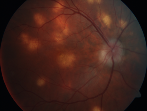 Multifocal Choroiditis - Pneumocystis - aspergillis - cryptococcus
31 year old male with anaplastic astrocytoma on chemotherapy with mild vision loss in the right eye.  LP did not reveal organism.  He was placed on a trial of anti-fungal medications and lost to follow-up
