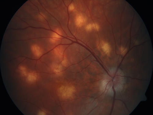Multifocal Choroiditis - Pneumocystis - aspergillis - cryptococcus
31 year old male with anaplastic astrocytoma on chemotherapy with mild vision loss in the right eye.  LP did not reveal organism.  He was placed on a trial of anti-fungal medications and lost to follow-up
