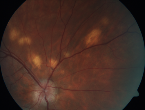 Multifocal Choroiditis - Pneumocystis - aspergillis - cryptococcus
31 year old male with anaplastic astrocytoma on chemotherapy with mild vision loss in the right eye.  LP did not reveal organism.  He was placed on a trial of anti-fungal medications and lost to follow-up
