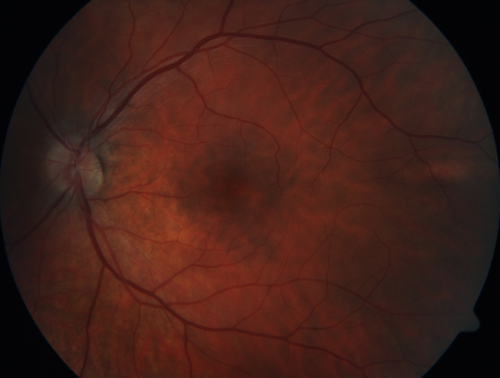 Multifocal Choroiditis - Pneumocystis - aspergillis - cryptococcus
31 year old male with anaplastic astrocytoma on chemotherapy with mild vision loss in the right eye.  LP did not reveal organism.  He was placed on a trial of anti-fungal medications and lost to follow-up
