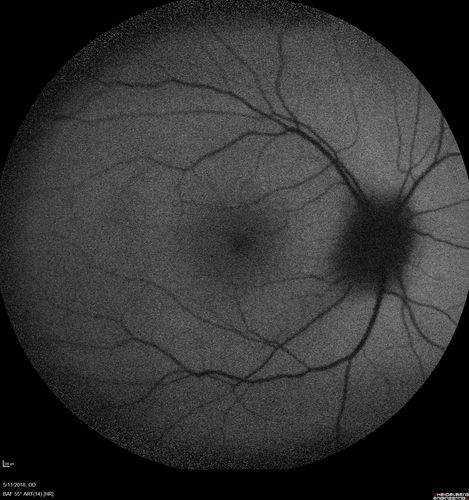 Multifocal Choroiditis - Pneumocystis - aspergillis - cryptococcus
31 year old male with anaplastic astrocytoma on chemotherapy with mild vision loss in the right eye.  LP did not reveal organism.  He was placed on a trial of anti-fungal medications and lost to follow-up
