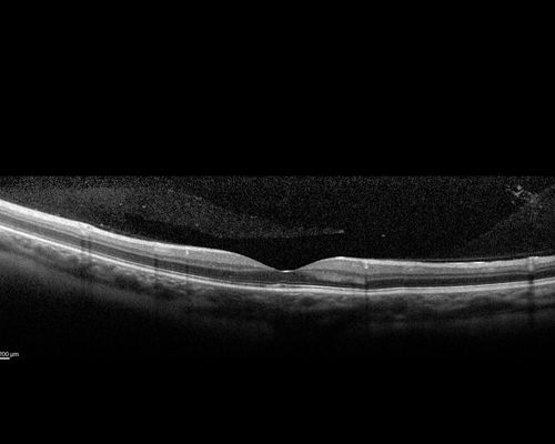 Multifocal Choroiditis - Pneumocystis - aspergillis - cryptococcus
31 year old male with anaplastic astrocytoma on chemotherapy with mild vision loss in the right eye.  LP did not reveal organism.  He was placed on a trial of anti-fungal medications and lost to follow-up
