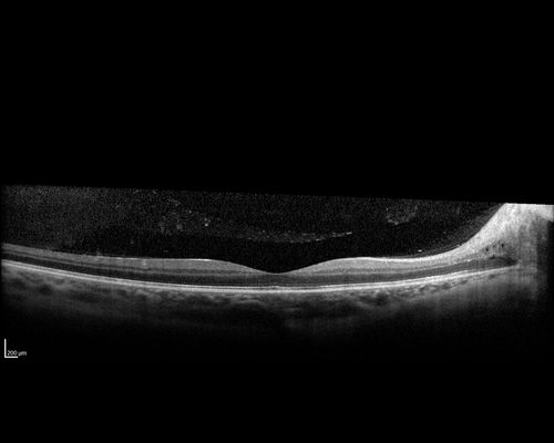 Multifocal Choroiditis - Pneumocystis - aspergillis - cryptococcus
31 year old male with anaplastic astrocytoma on chemotherapy with mild vision loss in the right eye.  LP did not reveal organism.  He was placed on a trial of anti-fungal medications and lost to follow-up
